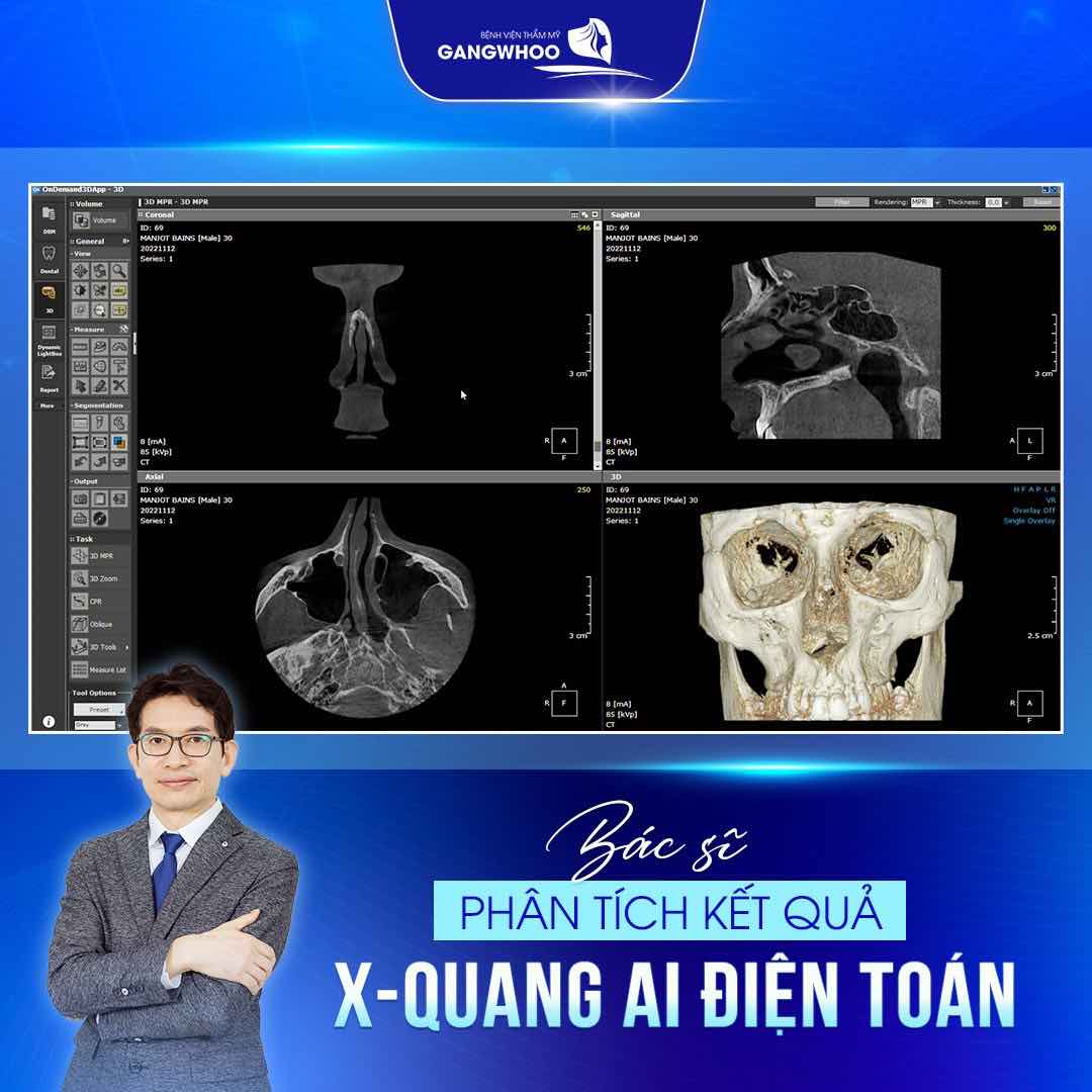 Công nghệ chụp X-quang AI điện toán ứng dụng trong thẩm mỹ mũi