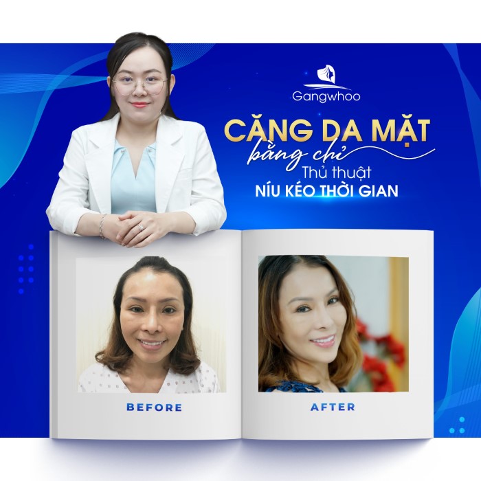 Căng da mặt bằng chỉ vàng ở đâu?