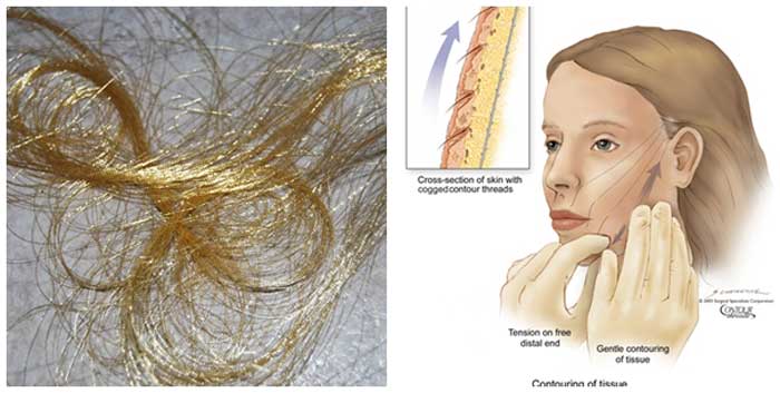 Căng da mặt bằng chỉ vàng là gì?