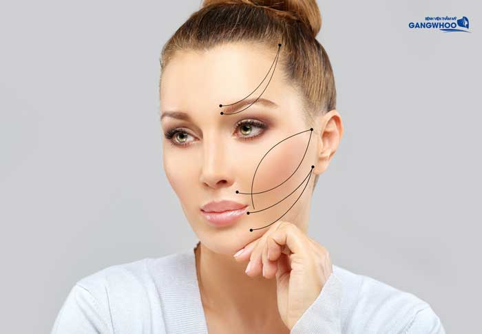 Hiệu quả khi căng da mặt bằng chỉ vàng