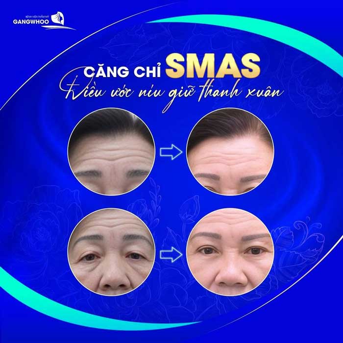 Căng da mặt Smas 3D bao nhiêu tiền?