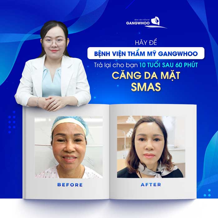 BVTM Gangwhoo căng da mặt Smas 3D