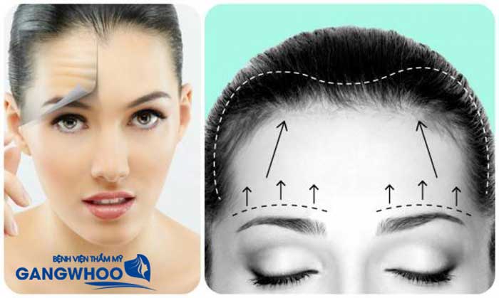 Ưu điểm căng da trán Perfect là gì?