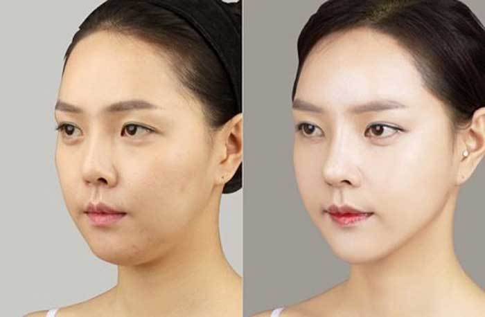 Căng chỉ da mặt