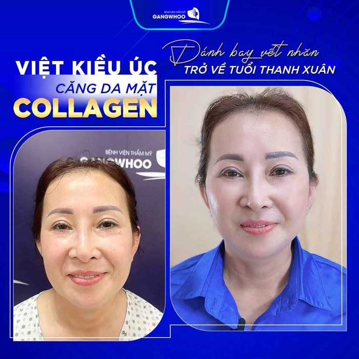 Làm gì để căng da mặt