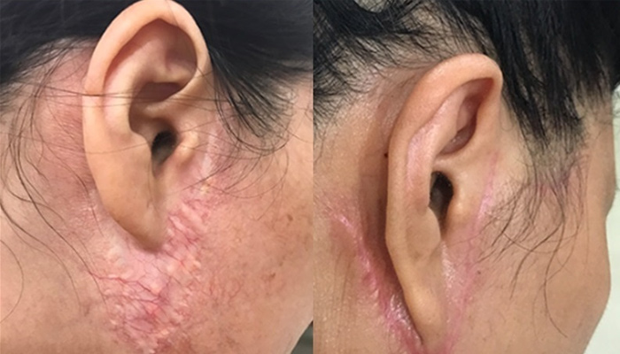 Những nguy cơ và tác dụng phụ tiềm ẩn của phương pháp căng da mặt bằng chỉ - biến chứng khi căng da mặt bằng chỉ