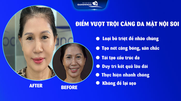 Căng da mặt nội soi