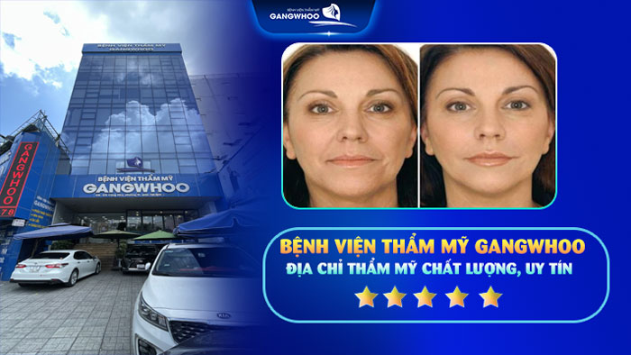 Căng da mặt thermage