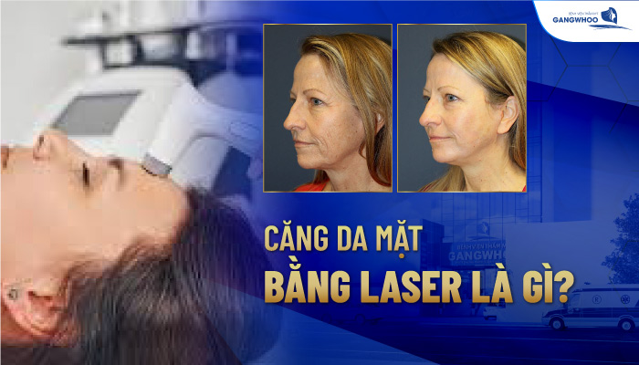 Căng da mặt bằng laser