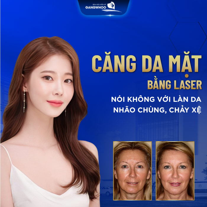 Căng da mặt bằng laser