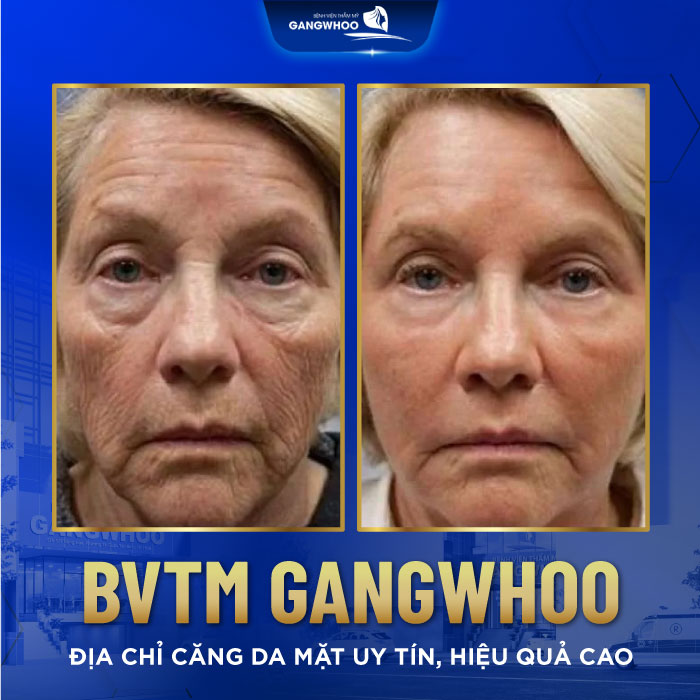 Căng da mặt bằng laser