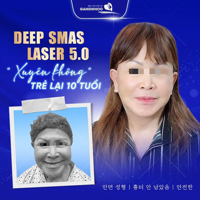 Căng Da Mặt Deep Smas Laser 5.0