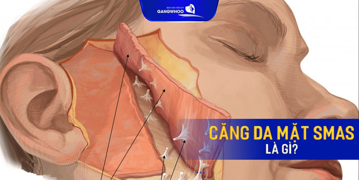Căng Da Mặt Deep Smas Laser 5.0