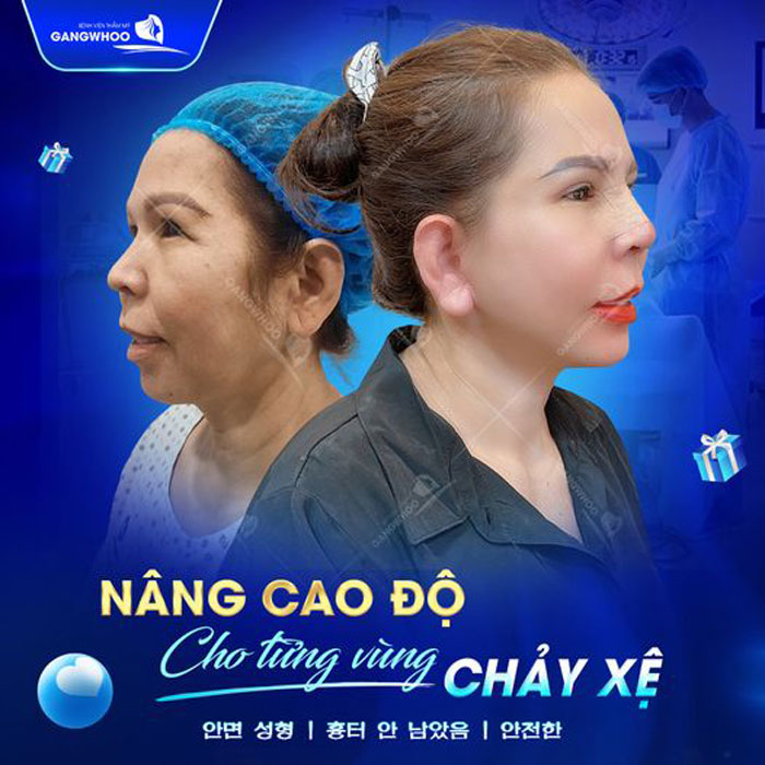 Căng da mặt nội soi