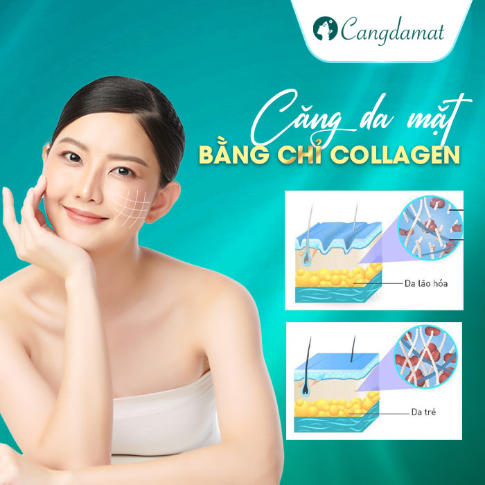 Tìm hiểu phương pháp cấy chỉ collagen căng da mặt