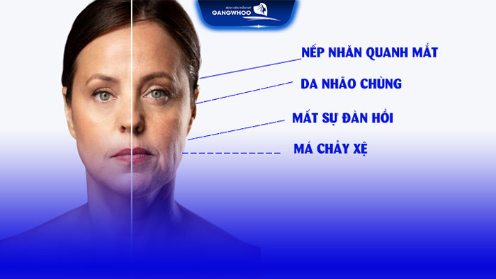 Căng da mặt chảy xệ