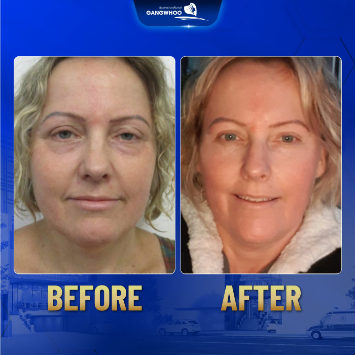 Căng da mặt 3D là gì