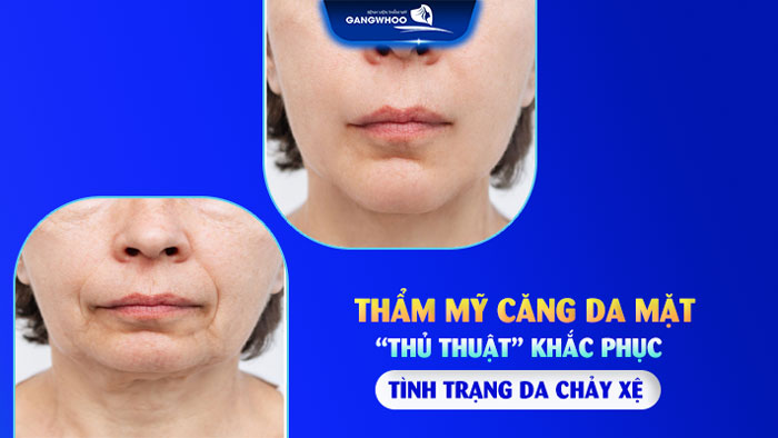 Căng da mặt chảy xệ