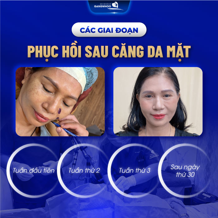 Căng da mặt bao lâu hồi phục