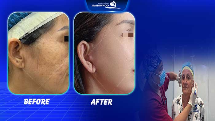 Căng da mặt bao lâu hồi phục