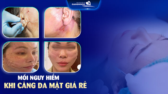 Căng da mặt giá bao nhiêu