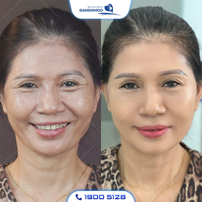 Phương pháp căng da mặt SMAS 3D phù hợp với ai?