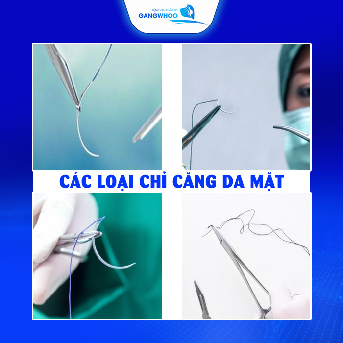 Căng Chỉ Da Mặt Giữ Được Bao Lâu