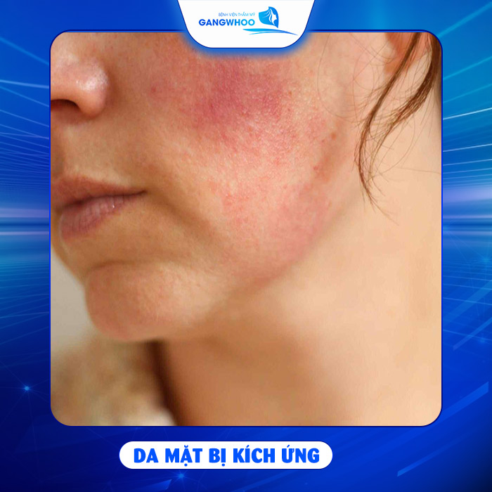 Tiêm Căng Bóng Da Mặt Có Hại Không