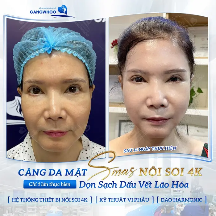 Top 11 Địa Chỉ Căng da Mặt Ở Quận 10 “Được Lòng” Khách Hàng