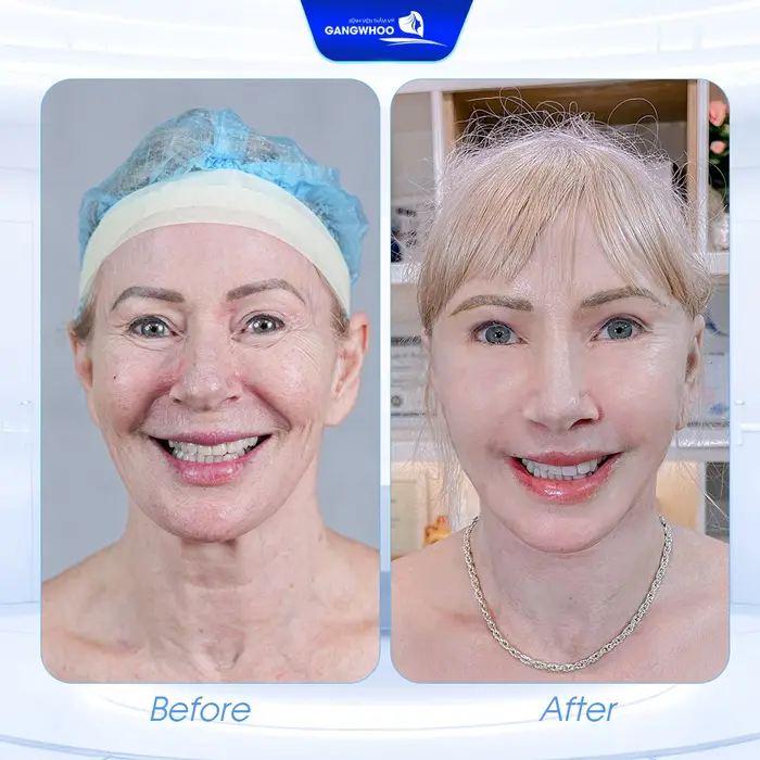 Top 10 Địa Chỉ Căng Da Mặt Ở Cần Thơ Giúp Bạn Trẻ Hơn Tuổi Thật