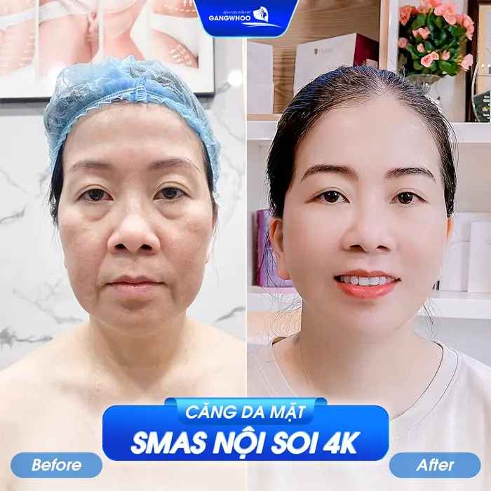 Căng da mặt ở Quảng Trị Cơ Sở Nào Giúp Bạn trẻ Ra Chục Tuổi