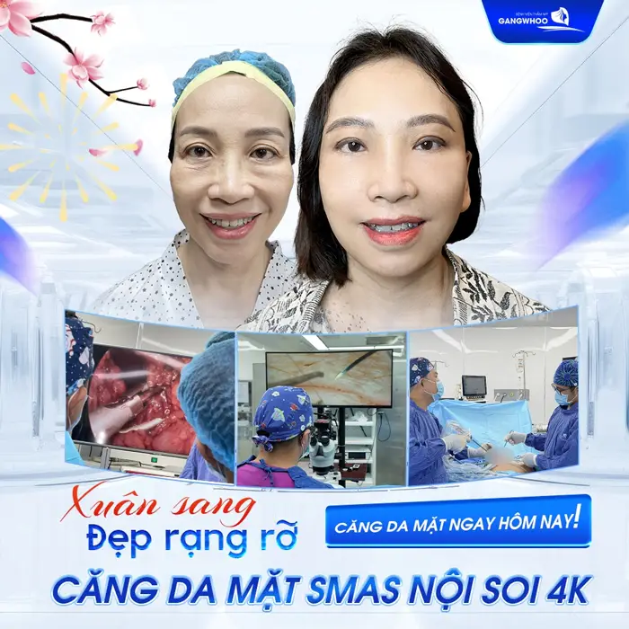 Sở hữu nét đẹp rạng rỡ sau căng da mặt Smas nội soi 4K tại BVTM Gangwhoo