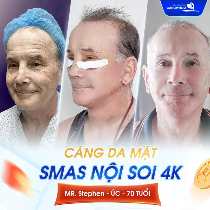 Dịch vụ căng da mặt tại BVTM Gangwhoo được đông đảo khách hàng quốc tế tin tưởng lựa chọn