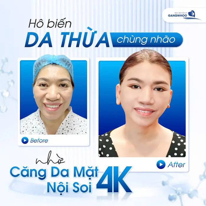 Tổng Hợp 4 Địa Chỉ Căng Da Mặt Ở Thủ Đức Uy Tín - Chất Lượng