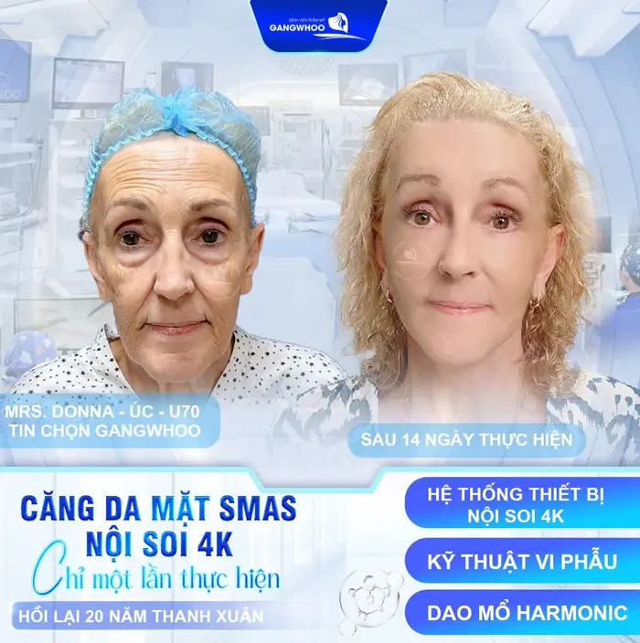 5+ Địa Chỉ Căng Da Mặt Ở Khánh Hòa Uy Tín Đẹp Bền Lâu