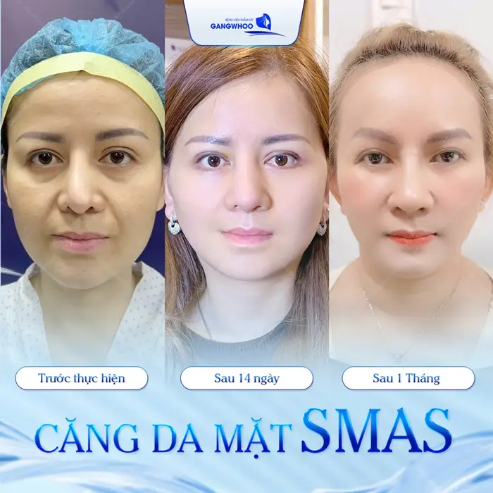 Hé Lộ 4 Nơi Căng Da Mặt Ở Nam Định Khách Hàng Khen Hết Lời