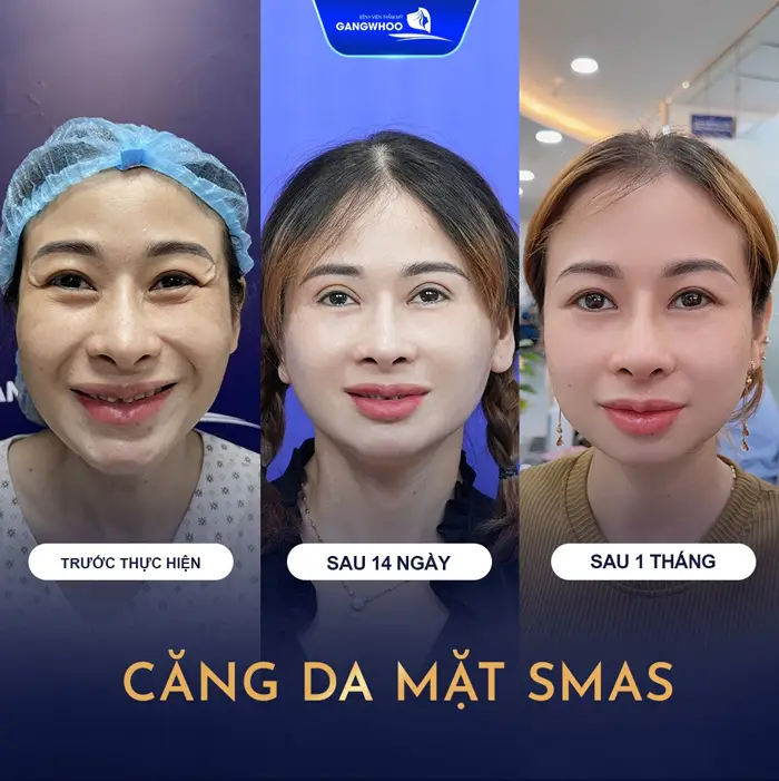 Tìm Hiểu Ngay 10 Địa Chỉ Căng Da Mặt Ở TPHCM Giúp Bạn Trẻ Hơn Tuổi Thật