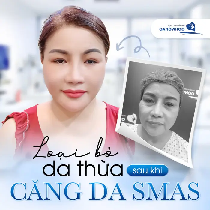 Căng da mặt ở Quảng Trị Cơ Sở Nào Giúp Bạn trẻ Ra Chục Tuổi