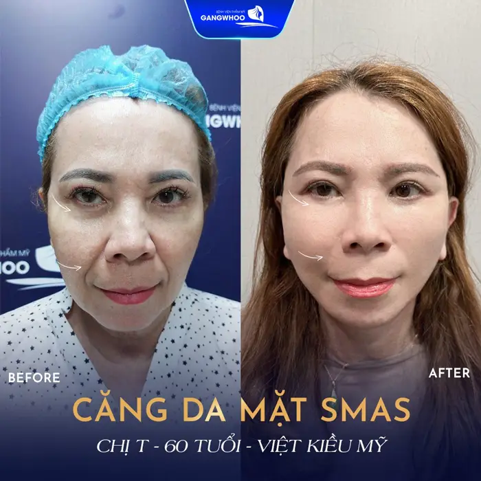 Top 5 Địa Chỉ Căng Da Mặt Ở Vĩnh Long Giúp Bạn Trẻ Ra 10 Tuổi