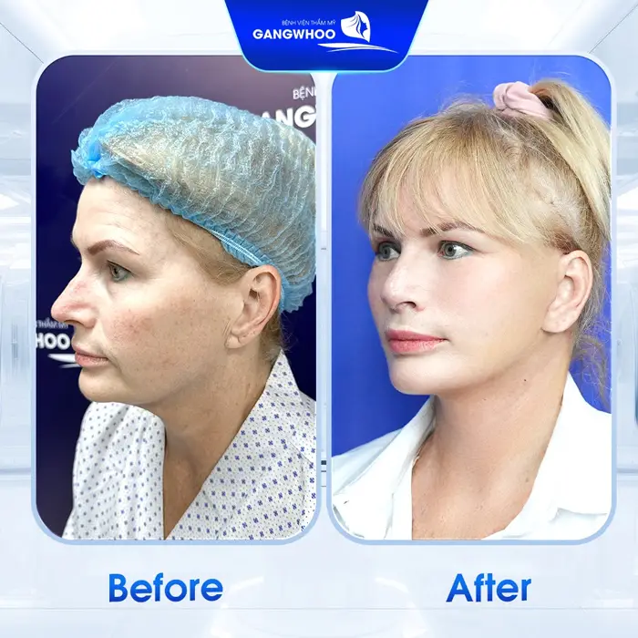 Nắm Lòng Top Các Cơ Sở Căng Da Mặt Ở Lai Châu Uy Tín