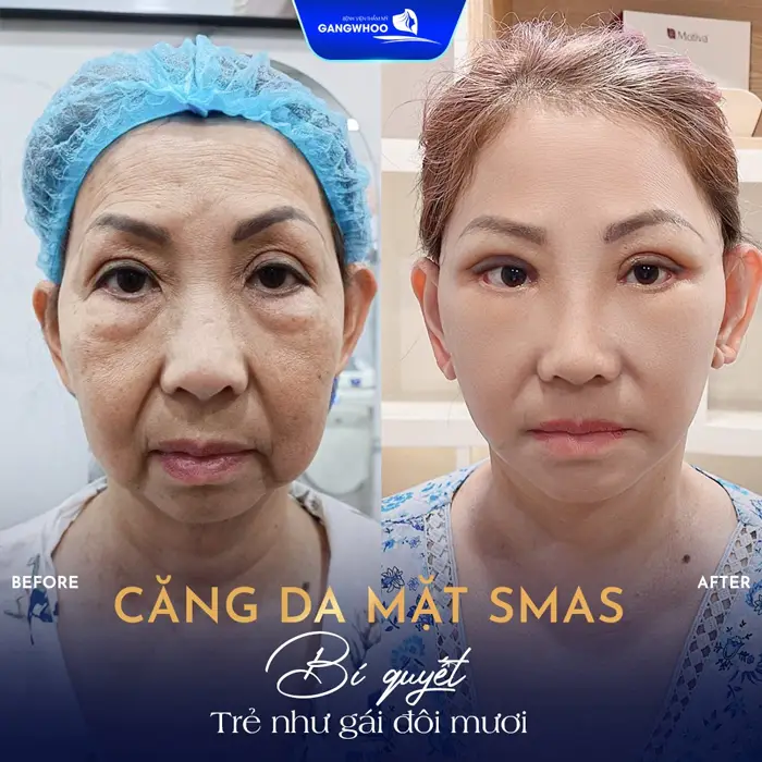 Bí Kíp “Hách Tuổi” Với 7 Cơ Sở Căng Da Mặt Ở Phú Yên Đừng Bỏ Qua