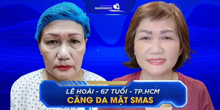 Bạn Cần Căng Da Mặt Ở Cà Mau? Đây Là Những Nơi Đáng Tin Cậy