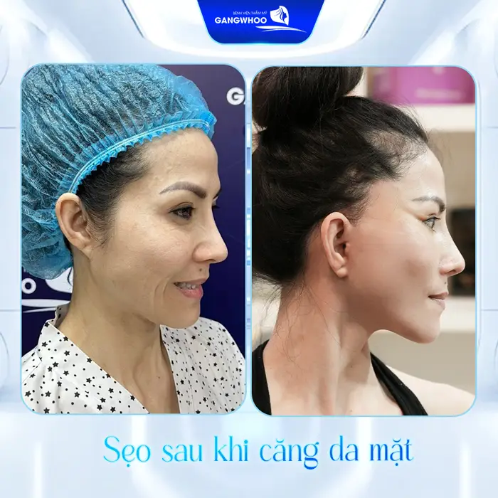 Bạn Sẽ Trẻ Hơn Chục Tuổi Với 6 Nơi Căng Da Mặt Ở Đắk Nông 