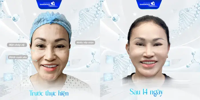 Say Bye Da Lão Hoá Với Top 5 Cơ Sở Căng Da Mặt Ở Bạc Liêu Này