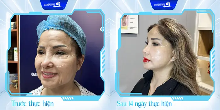 Điểm Danh Top 5 Cơ Sở Căng Da Mặt Ở Bến Tre Giúp Bạn Trẻ Lại