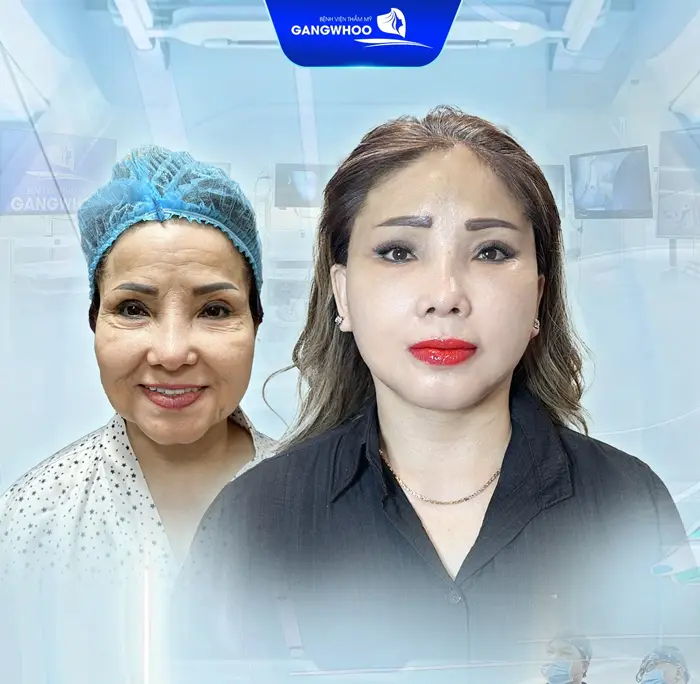 Say Bye Da Lão Hoá Với Top 5 Cơ Sở Căng Da Mặt Ở Bạc Liêu Này