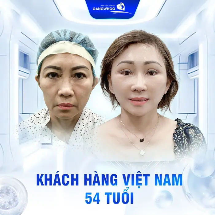 Bạn Cần Căng Da Mặt Ở Cà Mau? Đây Là Những Nơi Đáng Tin Cậy