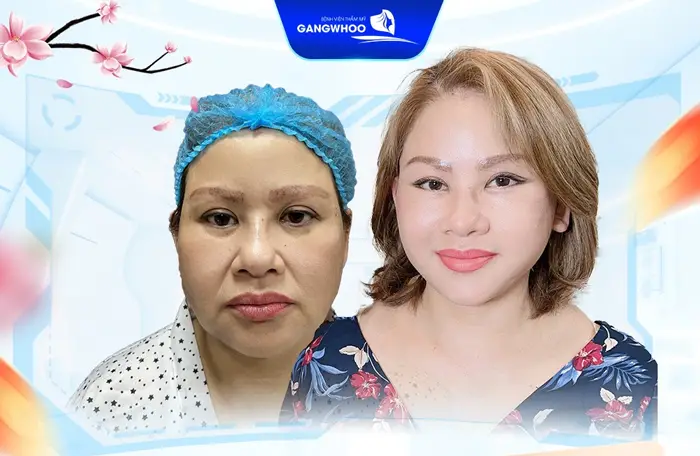 Bạn Cần Căng Da Mặt Ở Cà Mau? Đây Là Những Nơi Đáng Tin Cậy