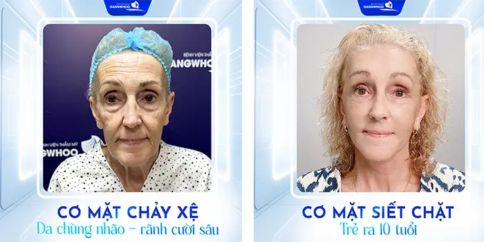 Trẻ Trung Bất Ngờ Với 7 Địa Chỉ Căng Da Mặt Ở Kon Tum Này