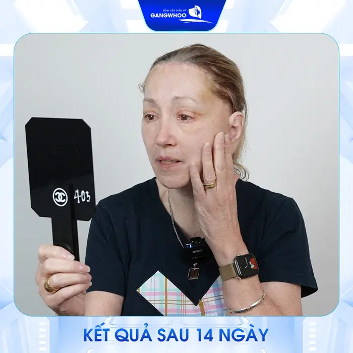 Tổng Hợp 5 Địa Chỉ Căng Da Mặt Ở Hòa Bình Uy Tín, Chất Lượng